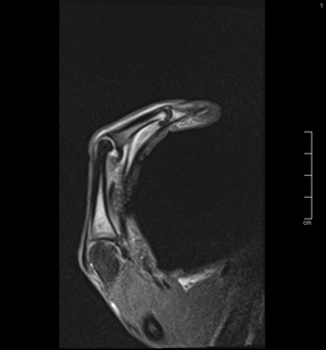 Röntgenbild einer Klettersportverletzung