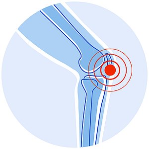 Patientenforum: Knieschmerzen – Spiegelung oder Kunstgelenk?