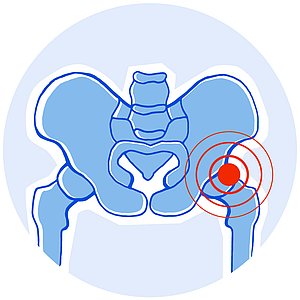 Patientenforum: Hüftschmerzen?