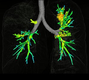 Symposium Bronchiektasen